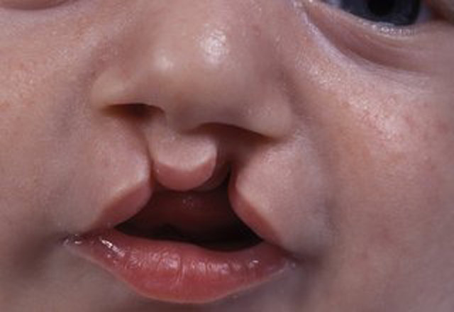 Cleft Lip Repair Painful