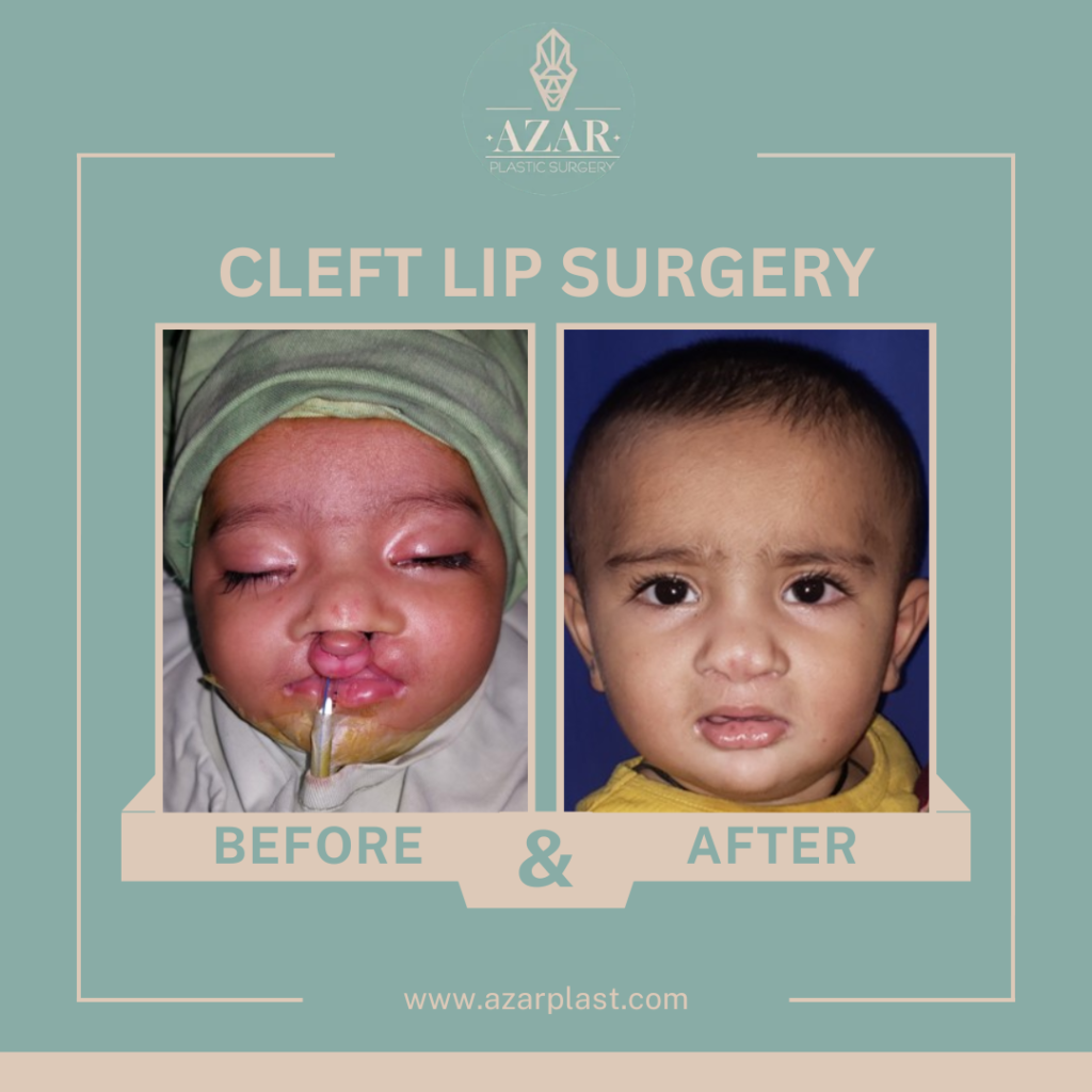 cleft-lip-surgery
