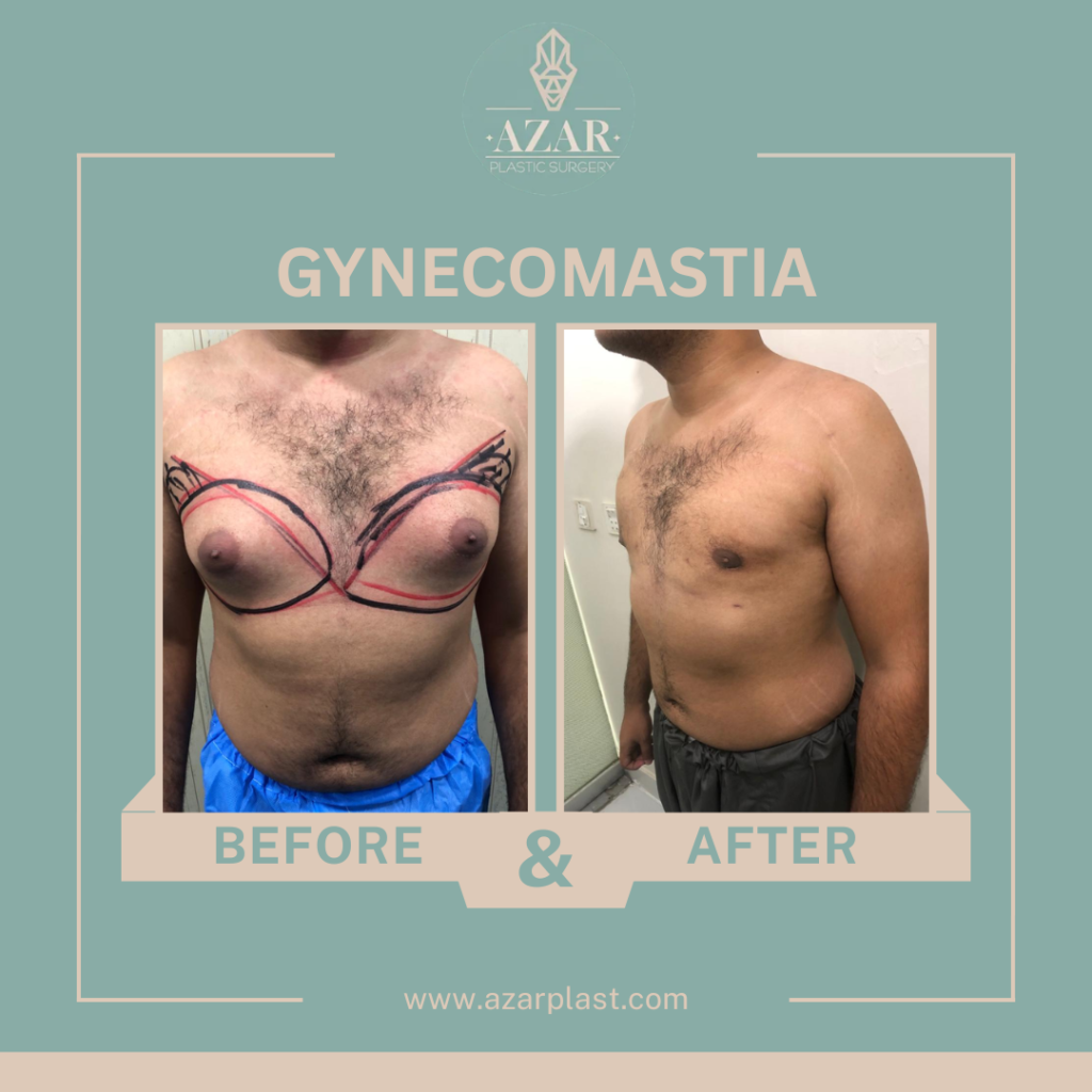 Gynecomastia