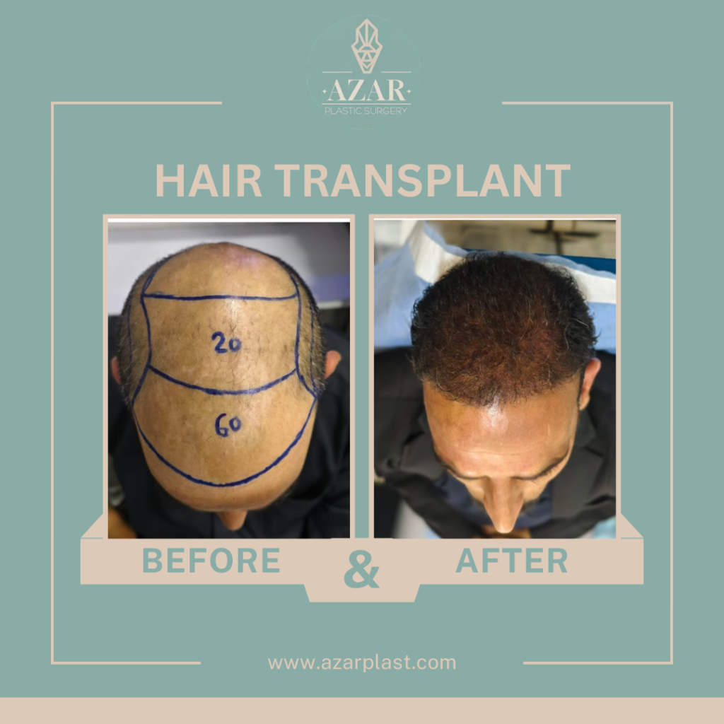 hair-transplant surgery