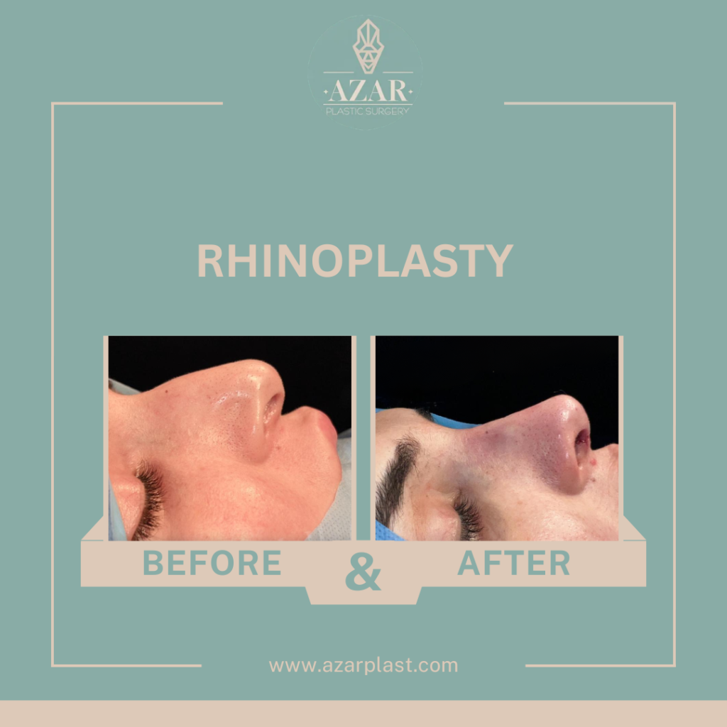 Rhinoplasty Surgery