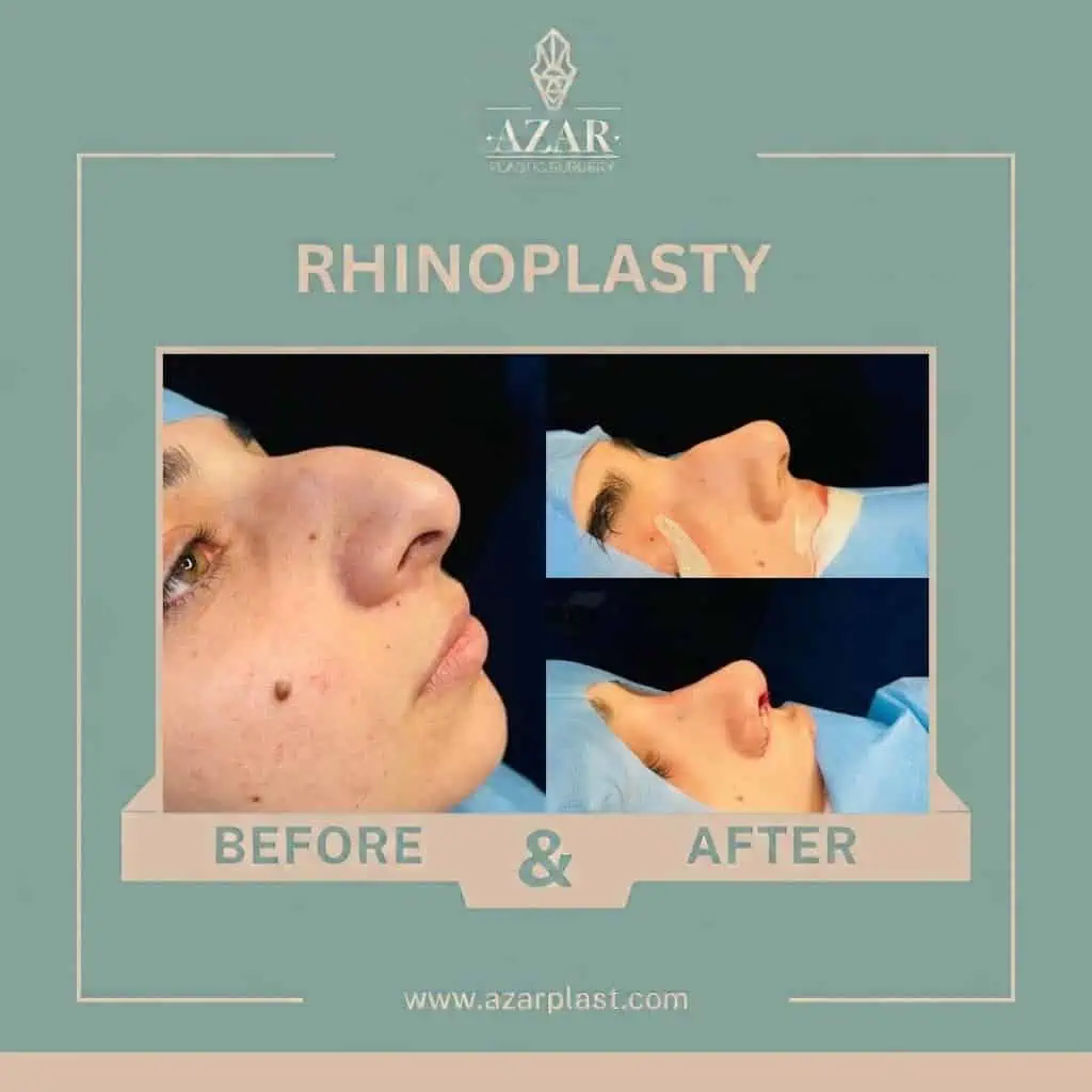 Rhinoplasty Before and After