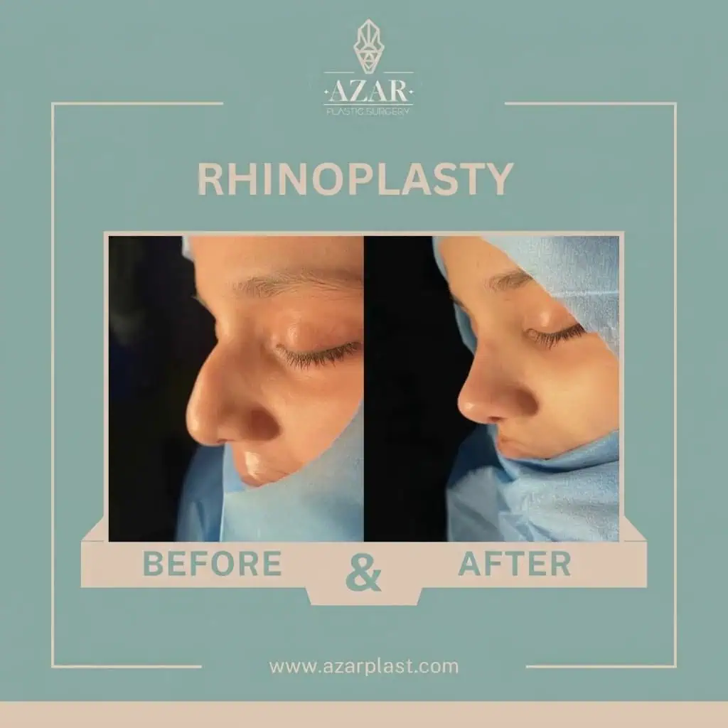 Rhinoplasty Before and After