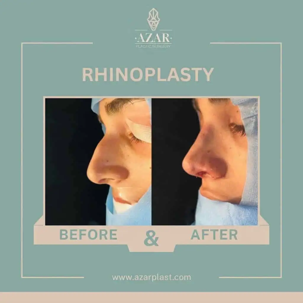 Rhinoplasty Before and After