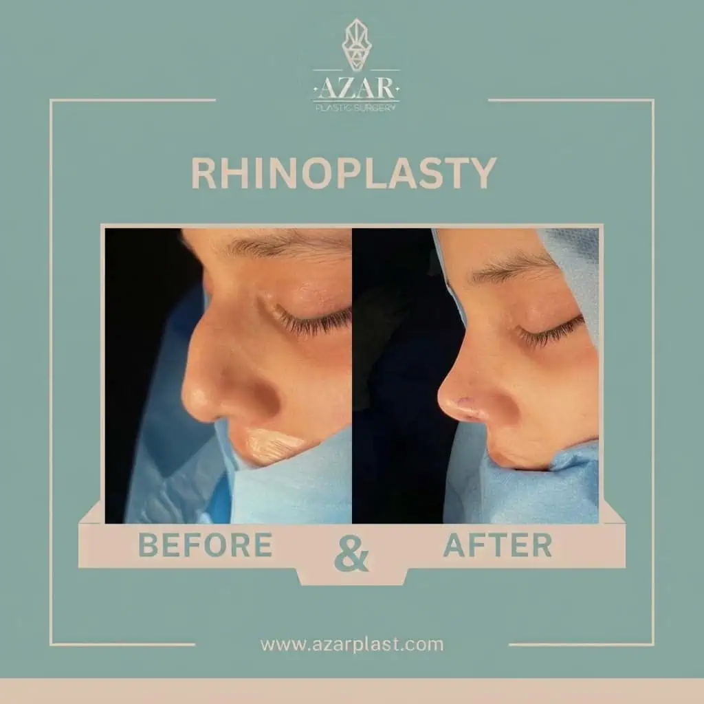 Rhinoplasty Before and After