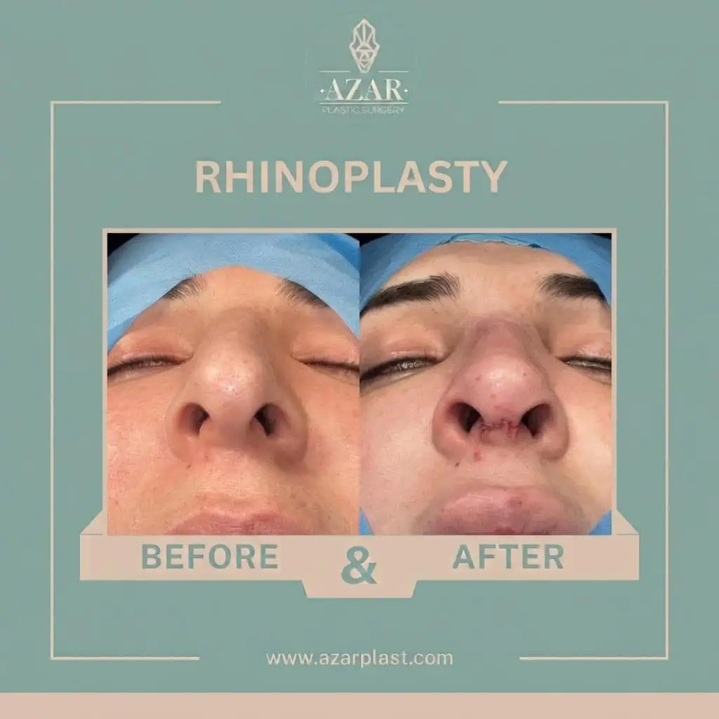 Rhinoplasty Before and After